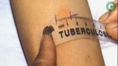 Tuberculosis: Descartan contagios masivos