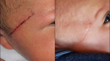 Piden explicaciones por el corte que recibió un bebe durante una cesárea