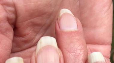 Infección en las uñas: Otra de las huellas del Covid19 