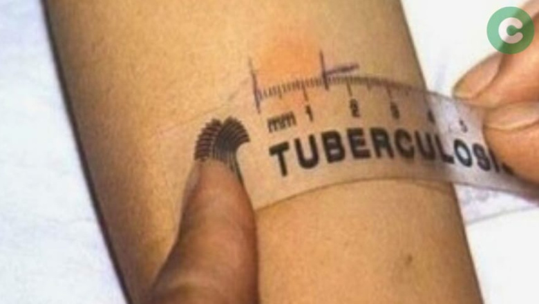 Tuberculosis: Descartan contagios masivos