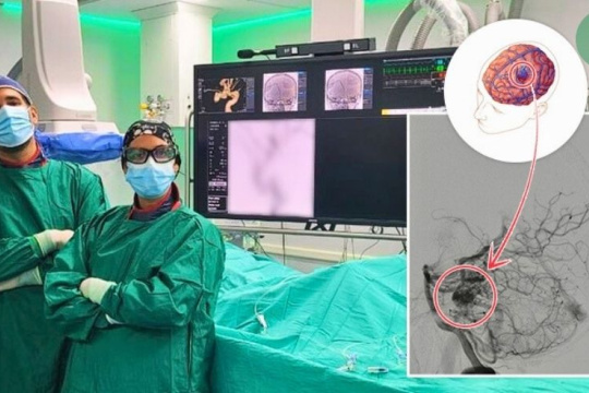 Operan con éxito una compleja malformación cerebral utilizando técnica pionera