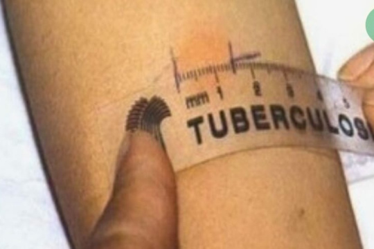 Tuberculosis: Descartan contagios masivos